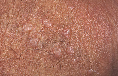 Papiloma humano labios genitales
